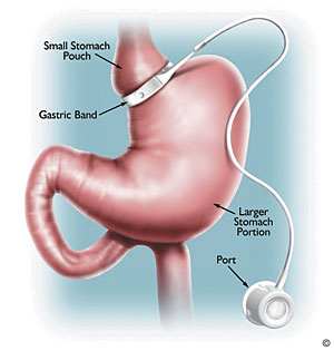 Lap band surgery like this could soon be funded by Australian taxpayers