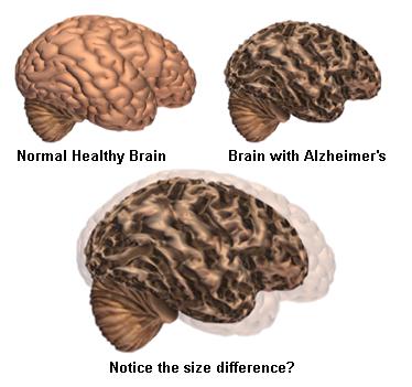 How a healthy brain compares to one with Alzheimer's. A new study shows a link between obesity and the brain disease.